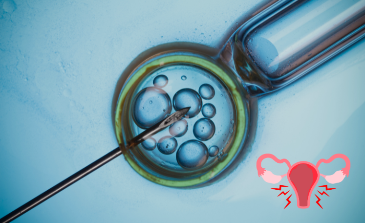 IVF Pregnancy with PCOS and Endometriosis